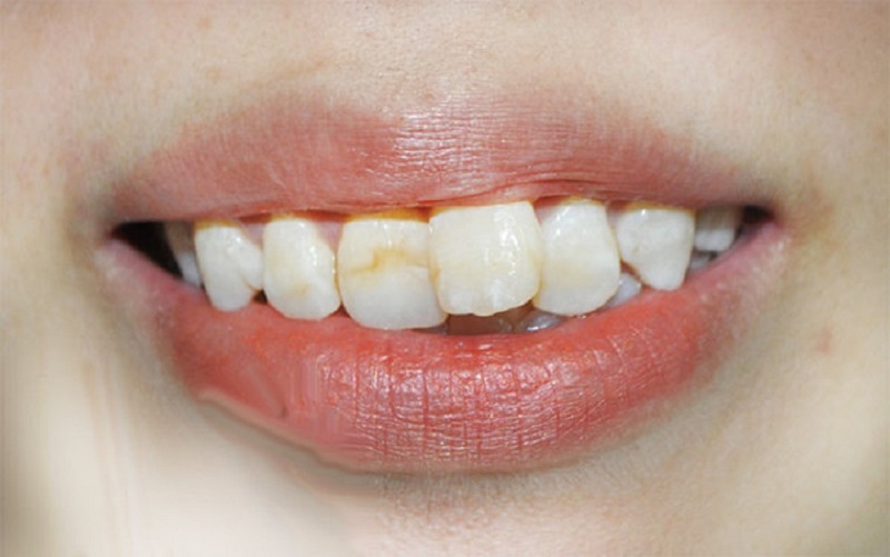 Bọc răng sứ cho răng mọc lệch cũng có nhiều lưu ý quan trọng
