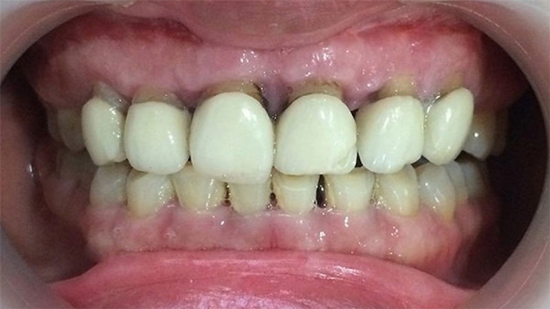 Răng sứ bị hở sẽ khiến vi khuẩn tích tụ, gây ra nhiều bệnh lý nghiêm trọng