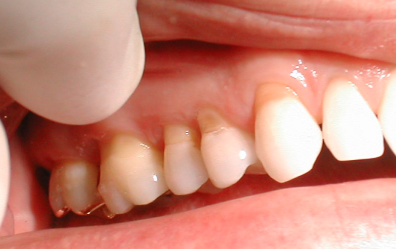 Răng sứ bị hở sẽ khiến cho cùi răng thật bị lộ ra ngoài rất mất thẩm mỹ