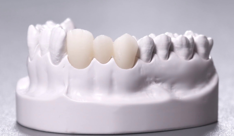 Khi lắp răng sứ kém chất lượng rất dễ gây kích ứng răng và bị hở