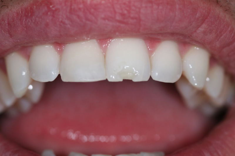 Trường hợp vết mẻ răng nhỏ thì có thể sử dụng phương pháp trám để phục hình