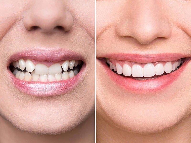 Răng sứ đem đến cho hàm răng vẻ ngoài trắng sáng, đều đẹp tự nhiên