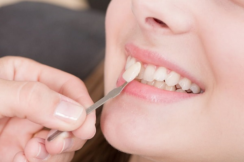 Răng sứ sẽ được điều chỉnh cho đến khi bạn cảm thấy hài lòng