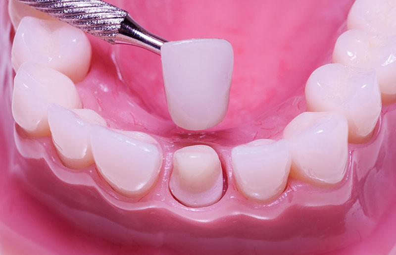 Răng tạm giúp bảo vệ răng thật khỏi các tác nhân gây hại