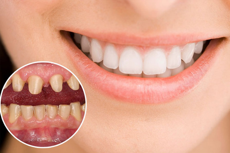 Bọc răng sứ giúp bạn sở hữu một hàm răng trắng sáng hơn