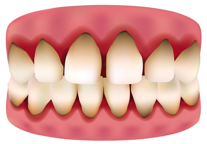 Khi bị đen viền nướu bạn cần phải thay răng sứ mới để không làm ảnh hưởng đến thẩm mỹ