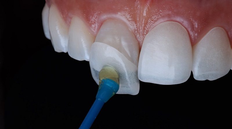 Khi răng sứ bị hỏng bạn hoàn toàn có thể thay thế chiếc răng sứ mới