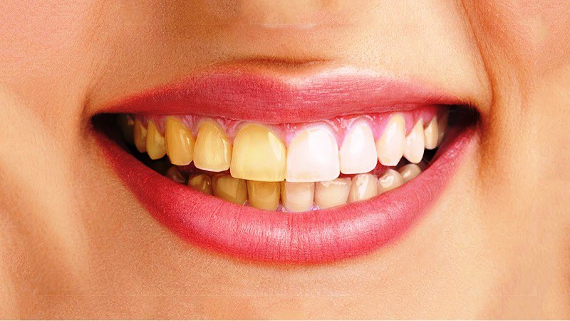 Những người có hàm răng bị ố vàng có thể tham khảo phương pháp tráng sứ răng
