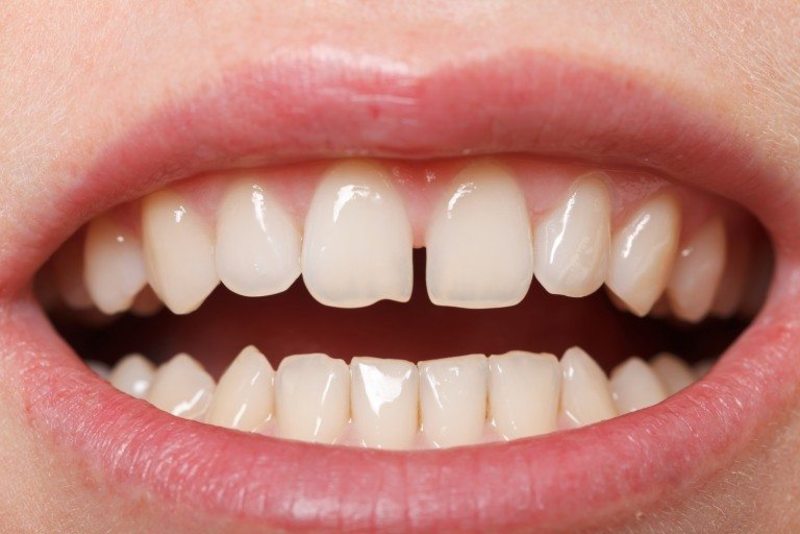 Người bị răng thưa nên thực hiện tráng sứ răng