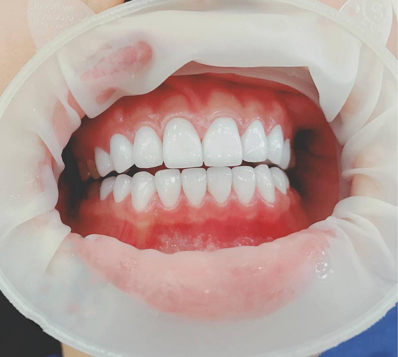 Tráng sứ răng hiện nay mang đến rất nhiều ưu điểm nổi bật