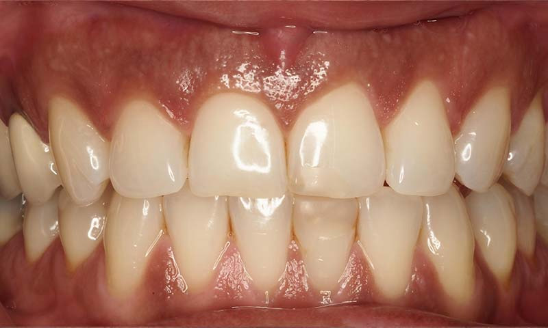 Nướu răng có sự chuyển màu sau khi bị bọc sứ