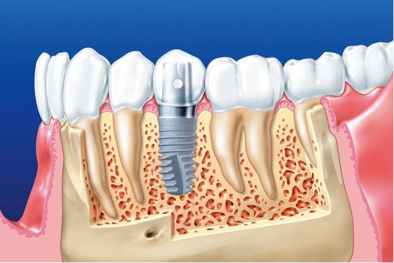Quá trình cấy trụ implant vào xương hàm được thực hiện khoảng 1 tiếng