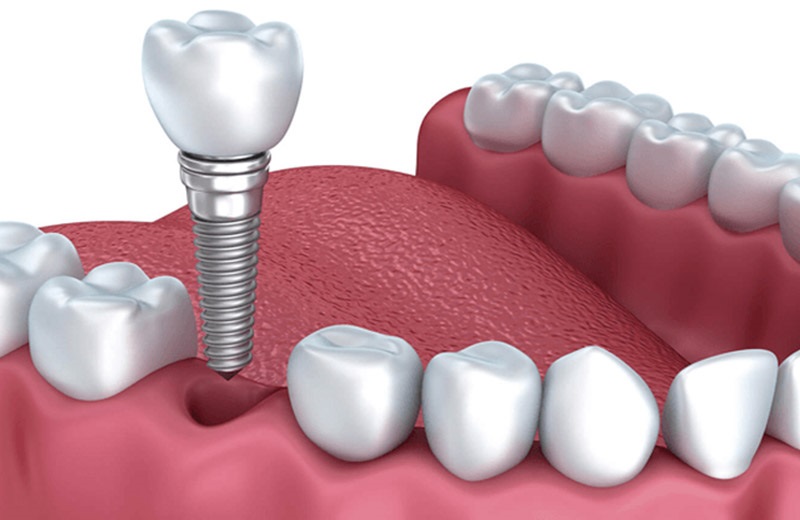 Một số mẹo chăm sóc răng sau cắm ghép implant đúng cách