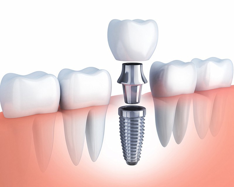 Trồng răng implant có đau không là phương pháp được nhiều người quan tâm