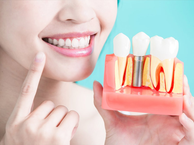 Quy trình cấy ghép răng implant là một trong kỹ thuật đòi hỏi cao về trình độ chuyên môn