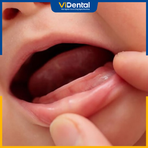 Có nhiều nguyên nhân khác nhau khiến bé 10 tháng chưa mọc răng