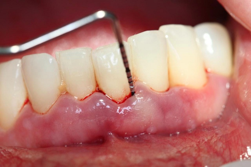 Viêm lợi ảnh hưởng đến răng của trẻ sau này
