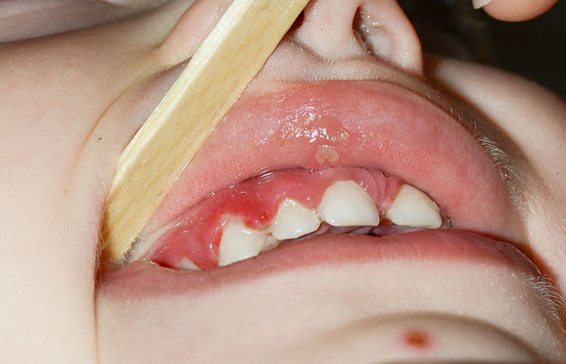 Bé bị viêm lợi nhiệt miệng là hiện tượng khá nguy hiểm, ảnh hưởng tới sự phát triển của trẻ