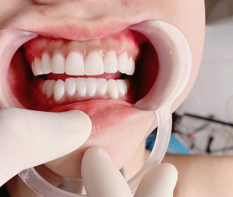 Bọc răng sứ bị đen viền nướu có thể gây ra các bệnh lý về nha chu