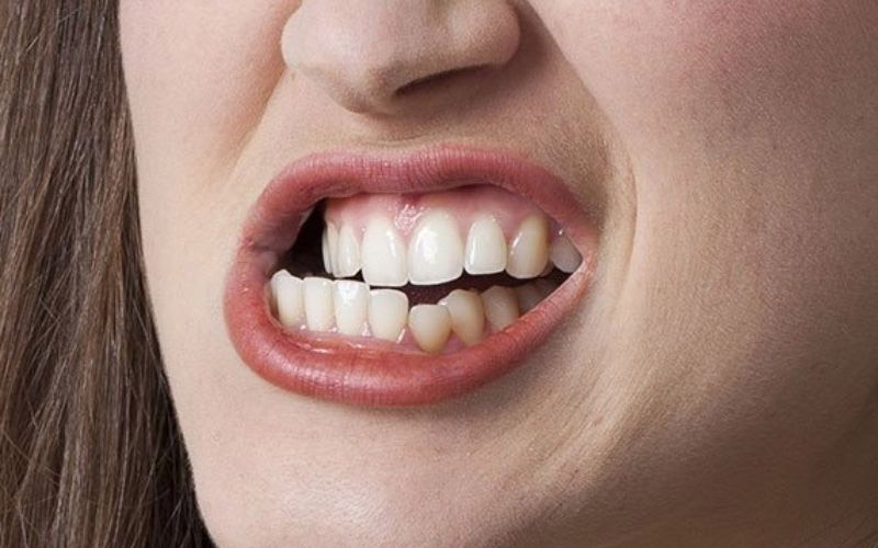 Ngứa nướu răng sau khi làm răng sứ là dấu hiệu bình thường
