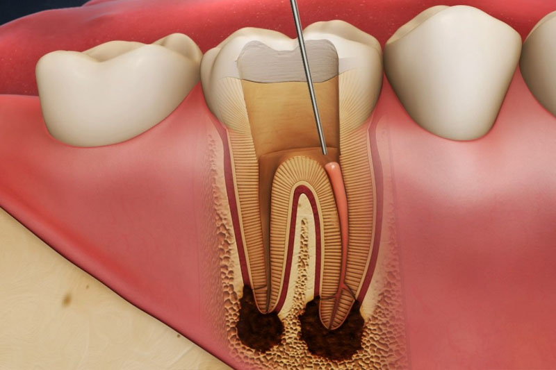 Răng sứ không đảm bảo chất lượng sẽ gây chết tuỷ răng thật