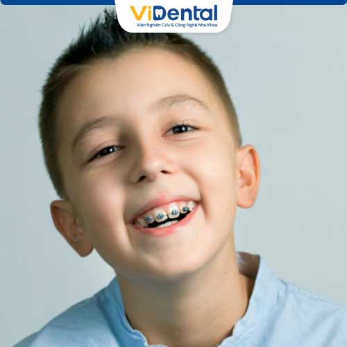 Độ tuổi niềng răng cho trẻ tốt nhất từ 12 – 16 tuổi