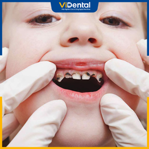 Trẻ em thường ăn kẹo dễ bị sâu răng