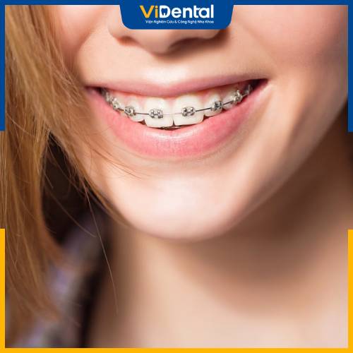 Giá niềng răng mắc cài rẻ nhất thuộc về niềng răng mắc cài kim loại thường