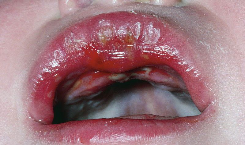 Viêm lợi, lở loét quanh miệng ở trẻ sơ sinh cảnh báo nhiễm Herpes