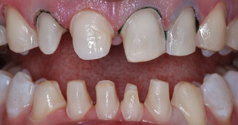 Nhược điểm của việc bọc răng sứ đó là xâm lấn răng thật