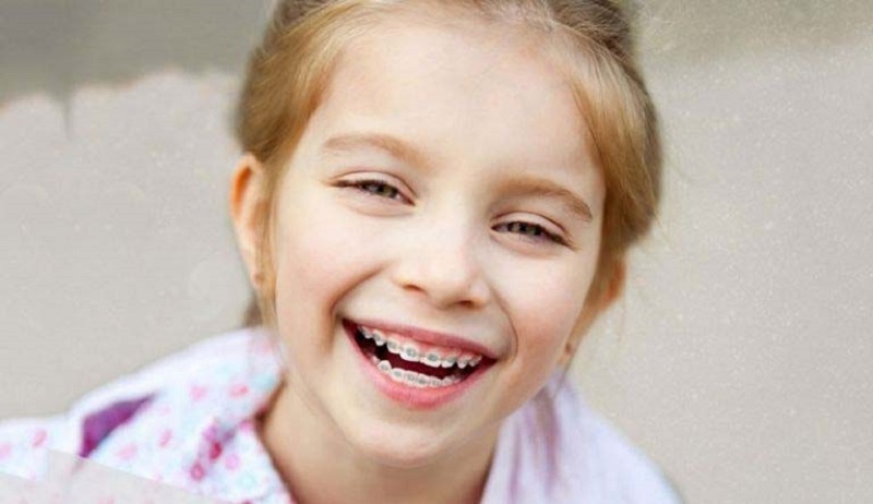 Niềng răng đúng thời điểm mang đến cho trẻ rất nhiều lợi ích