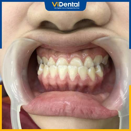 Tình trạng răng móm sẽ được khắc phục gần như hoàn toàn sau lộ trình niềng răng