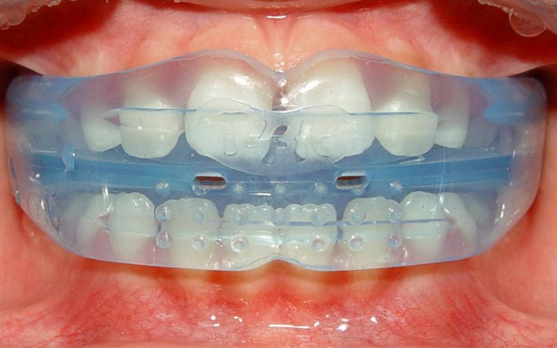 Phương pháp niềng răng hàm trainer còn được gọi là niềng răng 3 giai đoạn