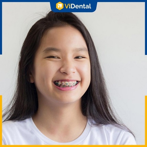 12 - 16 tuổi được chuyên gia đánh giá là độ tuổi lý tưởng để niềng răng