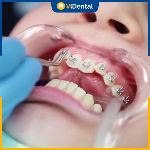 Phương pháp dùng mắc cài được nhiều phụ huynh lựa chọn khi niềng răng cho bé