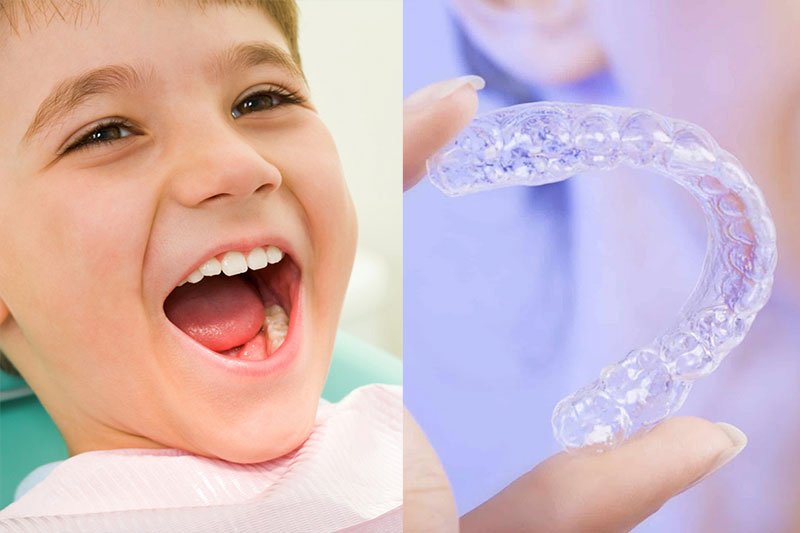Niềng răng trong suốt cho trẻ em là phương pháp chỉnh nha hiện đại, hiệu quả