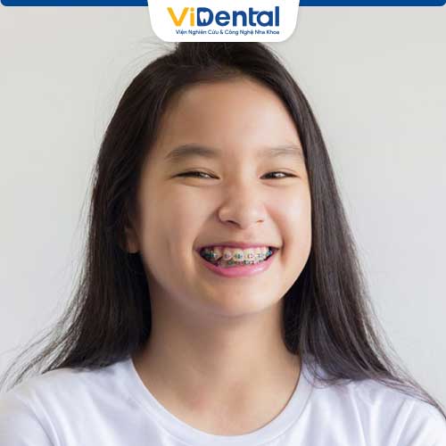 Chuyên gia nhận định việc căn thiệp chỉnh nha sớm giúp răng bé mọc thẳng, hàm đẹp