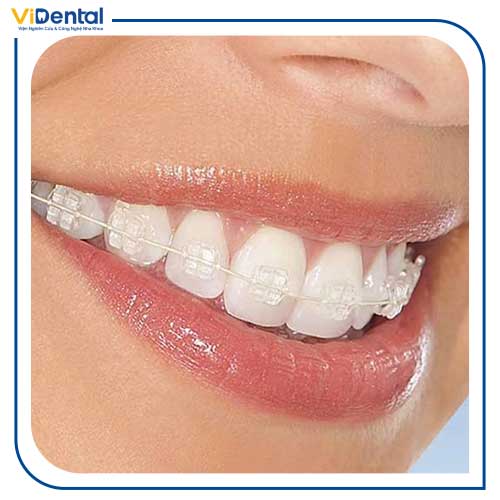 Một số trường hợp được chỉ định niềng răng để đảm bảo thẩm mỹ và chức năng hoạt động của răng