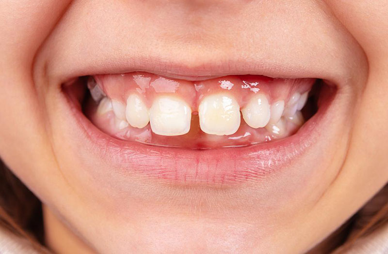 Răng mọc thưa ở trẻ em là tình trạng khá phổ biến