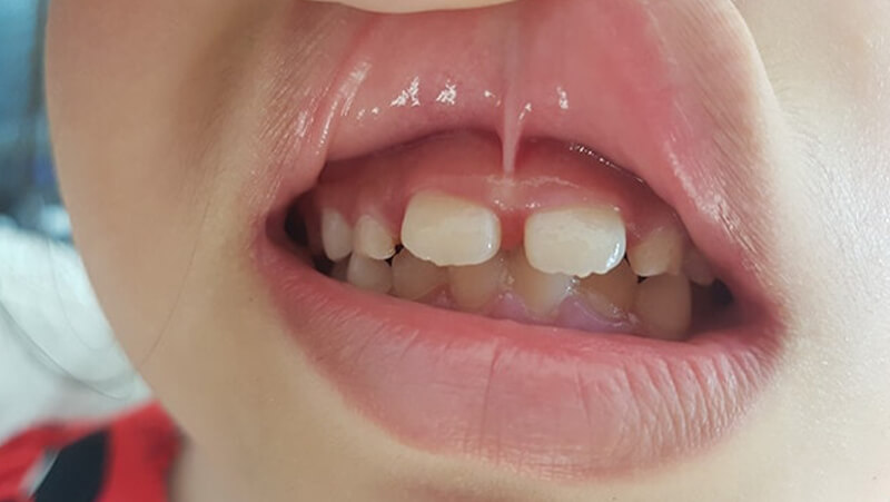 Dính thắng môi là một trong những nguyên nhân khiến răng cửa của trẻ bị thưa
