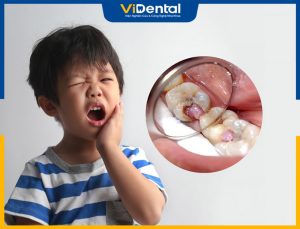 Răng Sâu Lồi Thịt Ở Trẻ Em: Triệu Chứng Và Các Cách Điều Trị