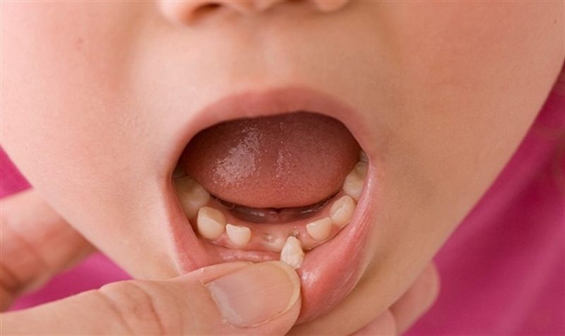Thay răng sữa mọc lệch quá sớm khiến các răng khác phát triển lệch theo