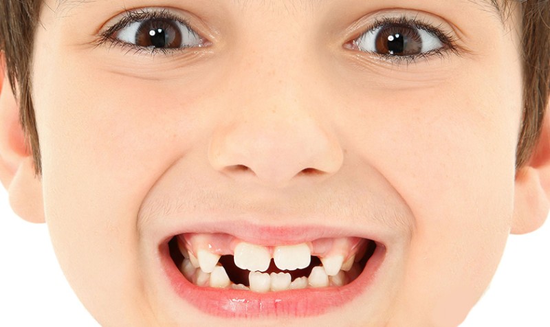 Răng sữa mọc sai vị trí không khắc phục sớm có thể gây ảnh hưởng không tốt tới thẩm mỹ sau này