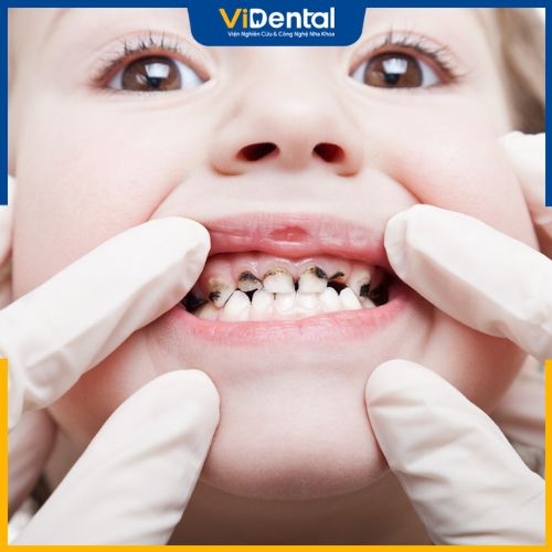 Sâu răng trẻ em là tình trạng phổ biến hiện nay