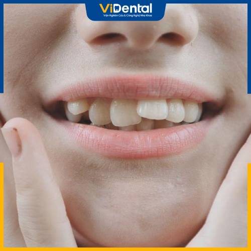Tình trạng hàm răng trước niềng là một trong những yếu tố ảnh hưởng tới chi phí niềng