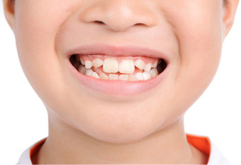 Sau nhổ răng, trẻ cần được chăm sóc răng miệng đúng cách