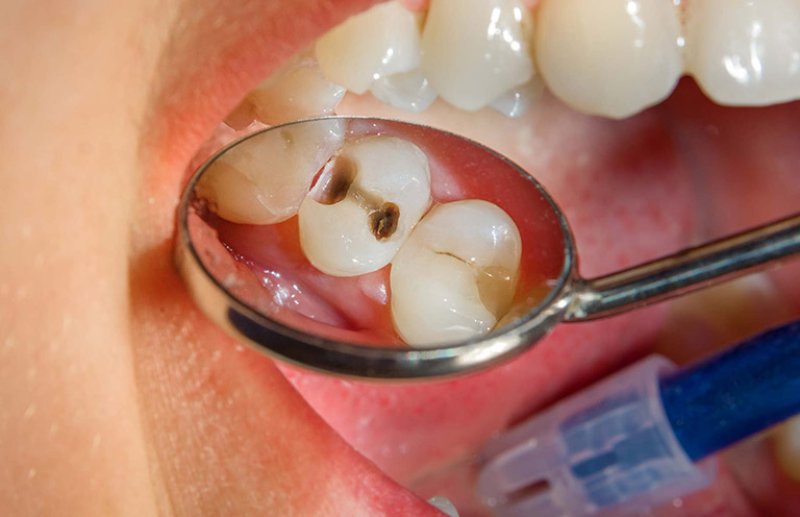 Sâu răng là một trong nhưng nguy cơ trẻ có thể gặp phải khi bị móm
