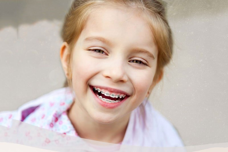 Niềng răng là phương pháp chữa móm mang lại hiệu quả cao
