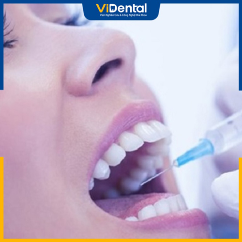 Thuốc tê được dùng để giảm đau trong quá trình làm răng