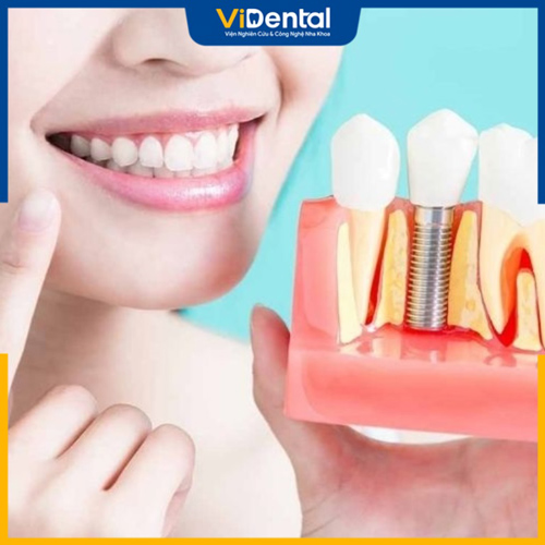 Cấy ghép implant là 1 trong 2 phương pháp trồng răng sứ cố định